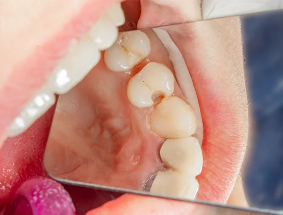 Dental Fillings for Children
